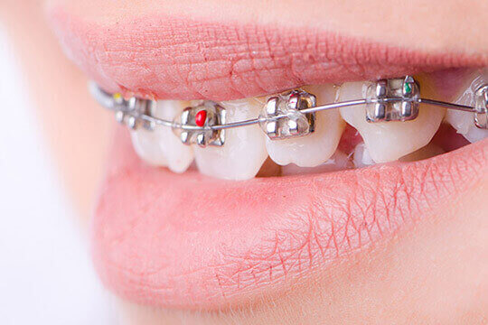 Braces & Orthodontics